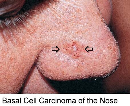 Radiation For Cancer Of The Nose