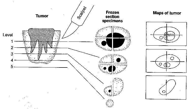 mohs.gif (10145 bytes)