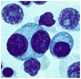 myeloma_bone_marrow.gif (7982 bytes)