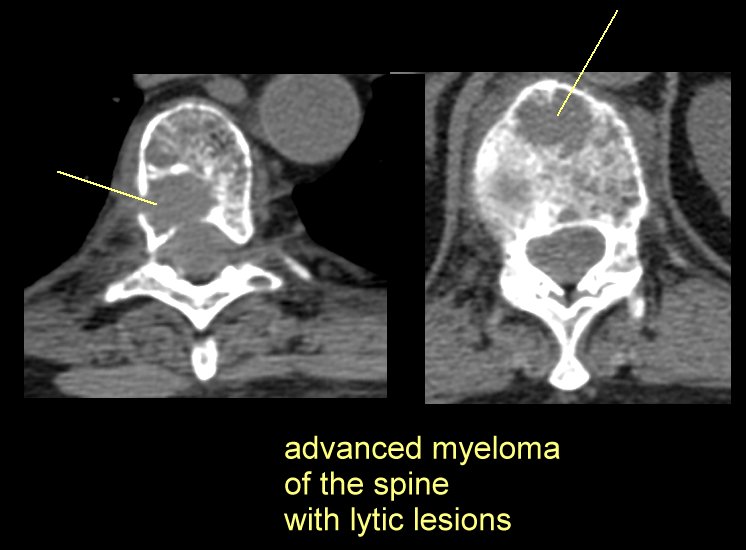 Multiple Myeloma or Plasmacytoma