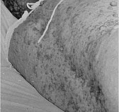 neurofibroma.jpg (9905 bytes)