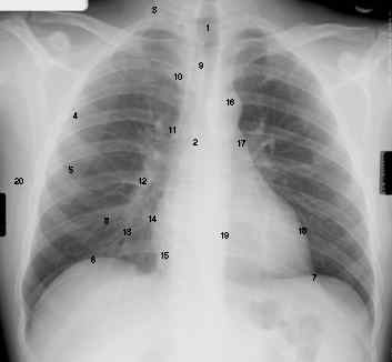 normal_chestXray.jpg (6228 bytes)