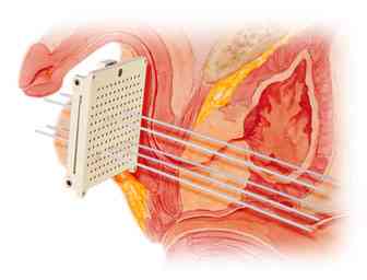 nucletron_needles2.jpg (7576 bytes)