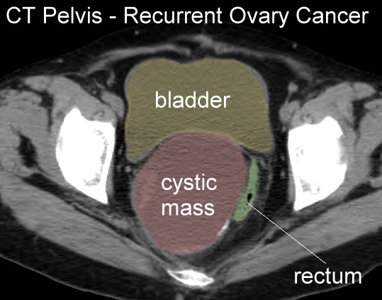 ovarian cancer with bowel obstruction)