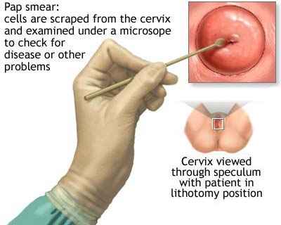pap_smear.jpg (13957 bytes)