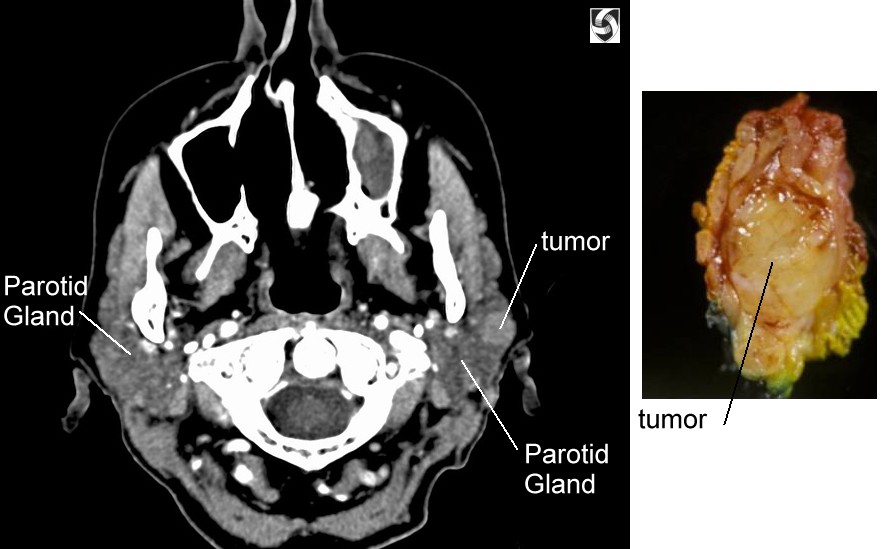 Parotid and Salivary Gland Cancer