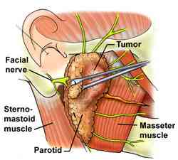 parotid_surgery.jpg (8291 bytes)