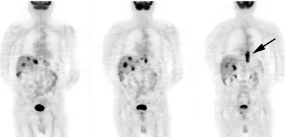 pet_esophagus.jpg (14376 bytes)