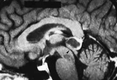 pineal_cyst.jpg (10659 bytes)