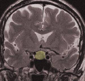 pituitary_bmc_sh2.jpg (15817 bytes)