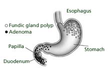 polyps_cleveland.jpg (4830 bytes)