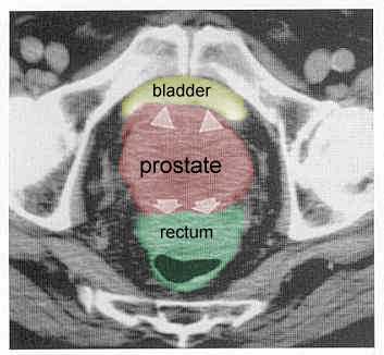 prostate_CT_t4_color.jpg (15522 bytes)
