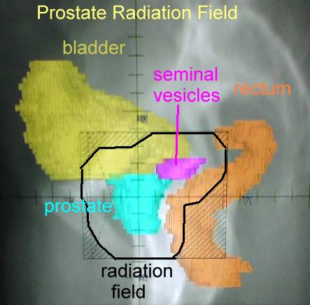 Prostate cancer, radiation, and rectal side effects 