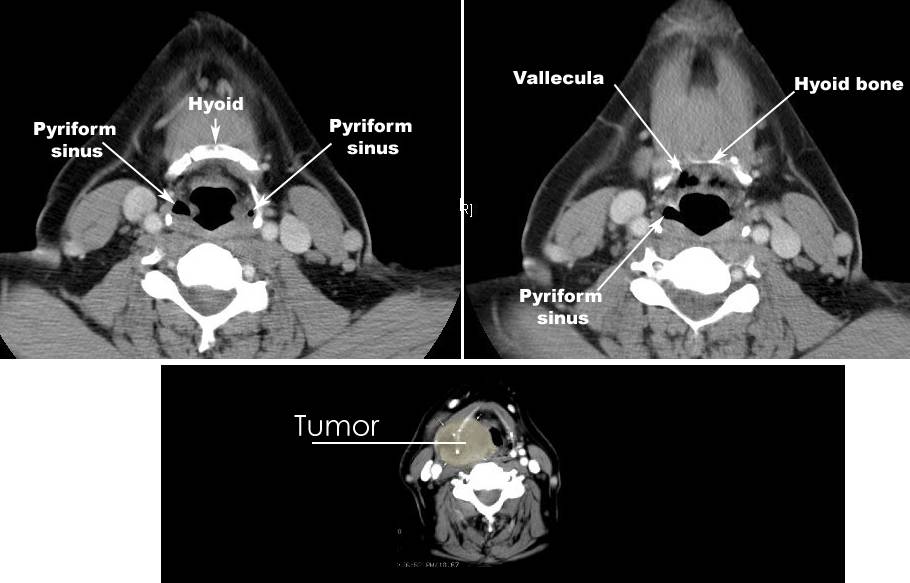 ct neck anatomy pyriform sinus
