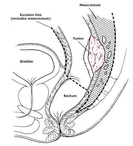 rectal_resection.jpg (12295 bytes)
