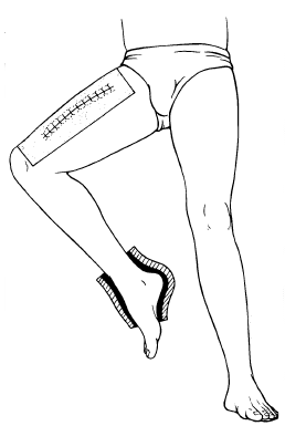 sarcoma_xrt.gif (8492 bytes)