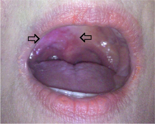 Oral Palate 17