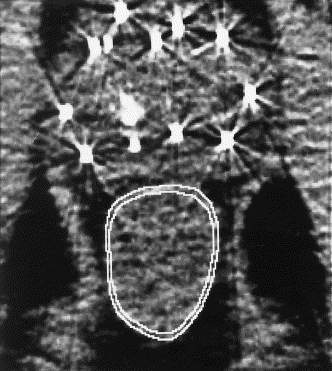 seed_rectal_waterman.gif (36112 bytes)
