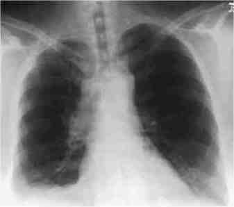 small_cell_typical_cxr.jpg (5019 bytes)