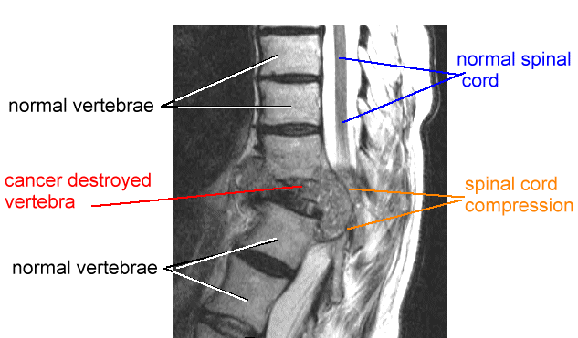What are some symptoms of tumors on the spine?