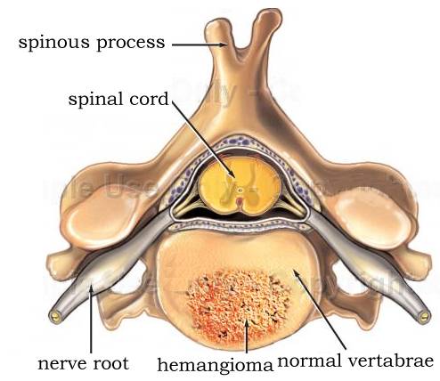 Hemangioma Hemangioma