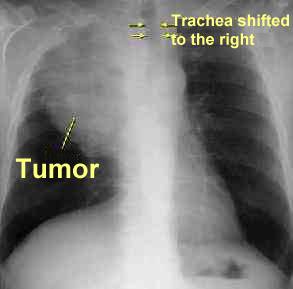 svc_cxr.jpg (5138 bytes)