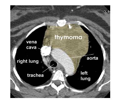 thymoma_bmc_sand.jpg (21848 bytes)