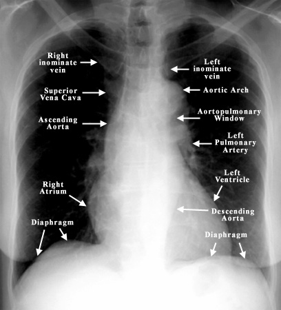 Normal Lung Anatomy