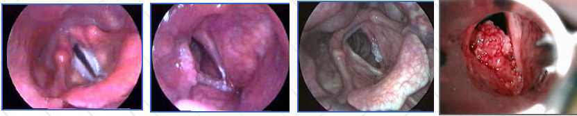 vocal_cord_cancer_pictures.jpg (17608 bytes)